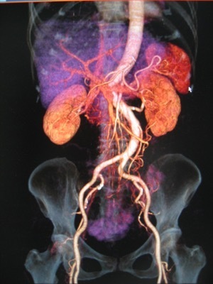 腹部血管造影（3D）