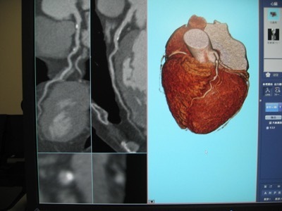 心臓血管造影（3D）